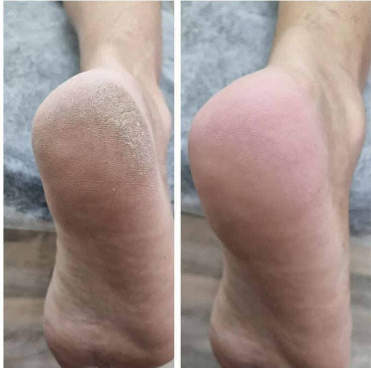 Electric Pedicure Foot File Callus Remover